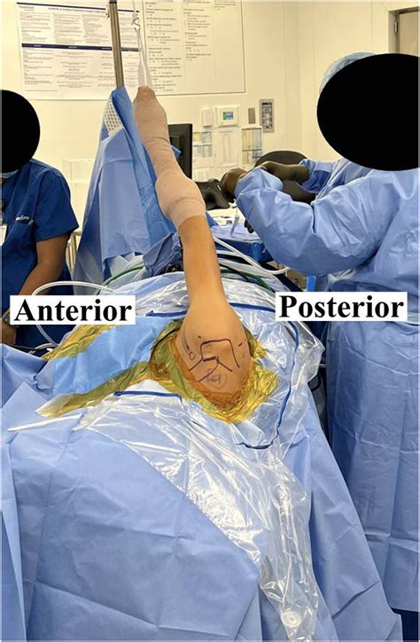 Arthroscopic Modified McLaughlin Procedure and Posterior Labral Repair ...