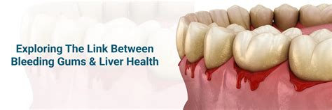 The Surprising Link: Explore Bleeding Gums and Liver Health