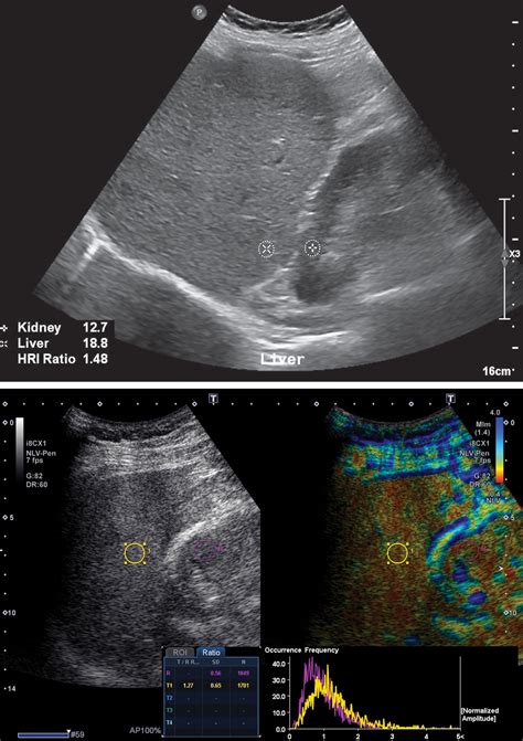 Liver Disease Ultrasound Images at Amber Royalty blog