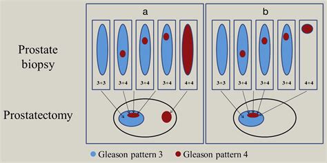 Gleason grading of prostate cancer: a pragmatic approach - Diagnostic Histopathology