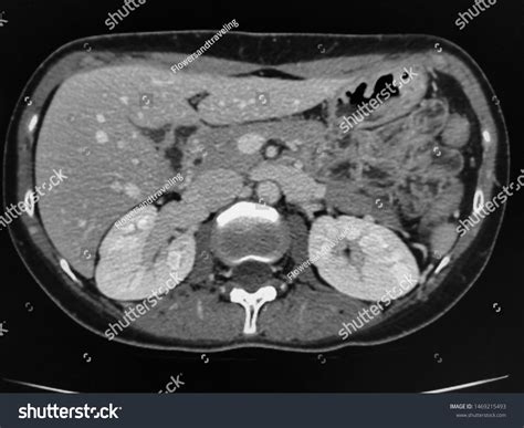 Normal Ct Scan: Over 358 Royalty-Free Licensable Stock Photos ...