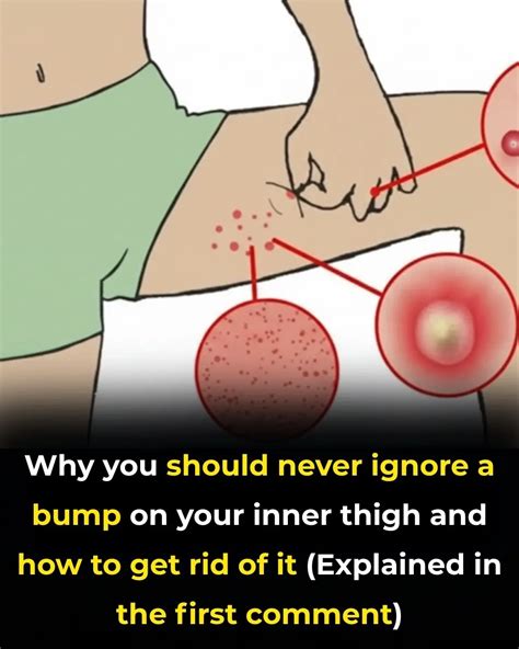 The Most Effective Ways to Get Rid of Bumps on Inner Thigh (Backed by ...