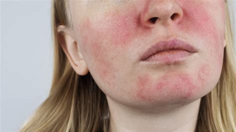 What is Behind Rosacea Flare-Ups | Georgia Skin Specialists