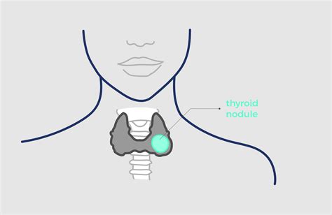 Thyroid nodules - Echotherapy