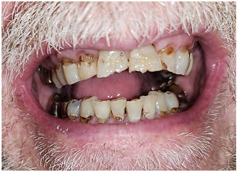 Prophylactic Use of Pentoxifylline and Tocopherol for Prevention of ...