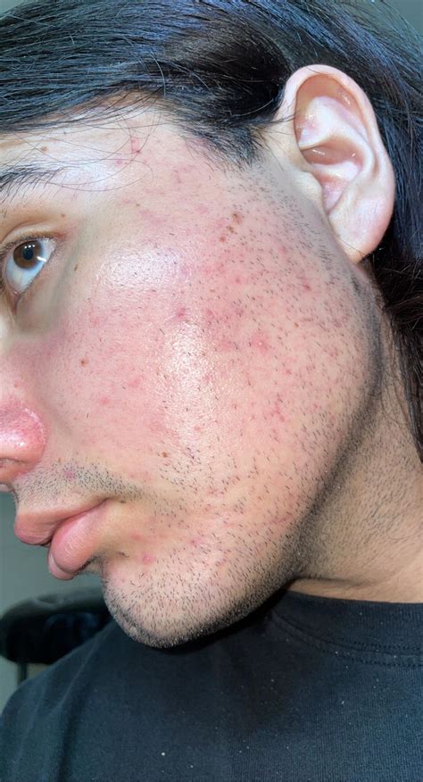 [skin concerns] so i have had these red spots on my face for a while now and i don’t know what ...