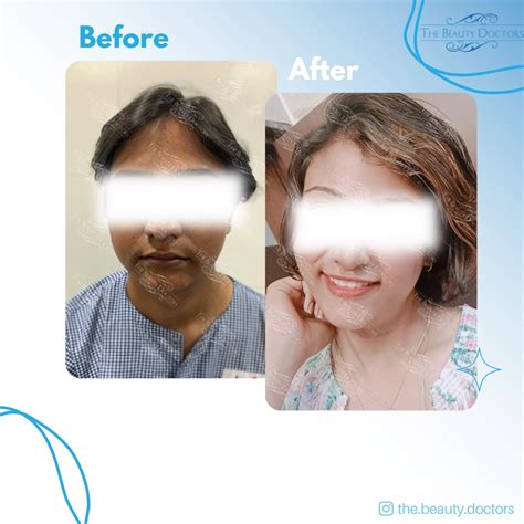 Best Gender Reassignment / Affirmation Surgery in Mumbai