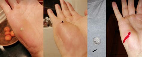 Image result for Splinter in Hand