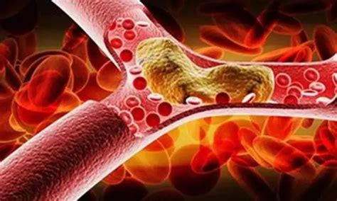 Thrombectomy after stroke due to basilar-artery occlusion improves ...