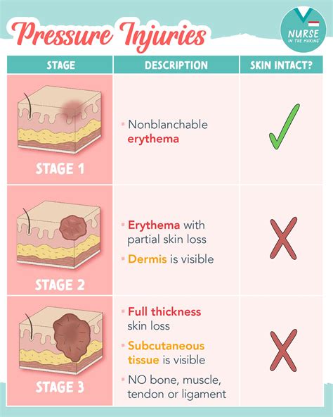 Kristine Tuttle | - Pressure Injury Stages Explained- ⭐️A pressure ...