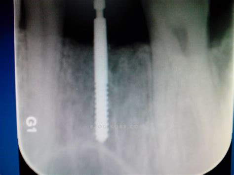 Basic种植牙系统3D导板种植出来的鼻窦内提升-曾瀚的博客-KQ88口腔博客