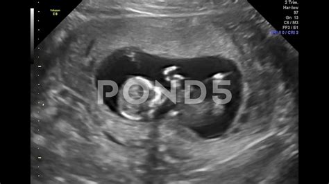 Baby Ultrasound At 12 Weeks