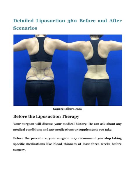 PPT - Liposuction 360 Before And After: A Complete Journey PowerPoint Presentation - ID:11383853