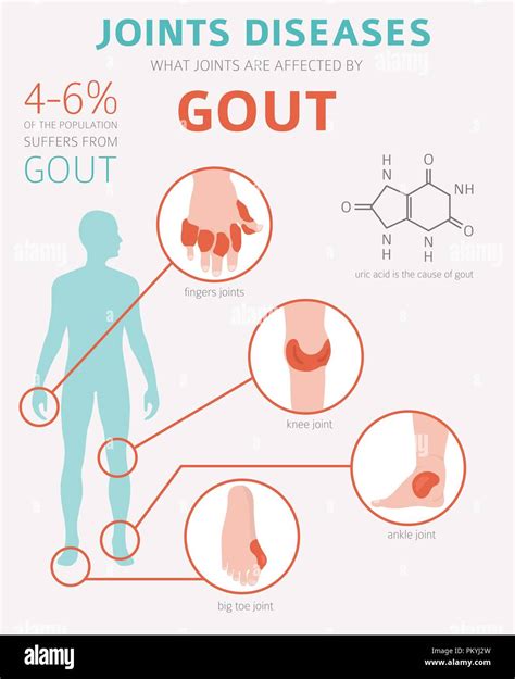 Uric Acid Treatment Medicine