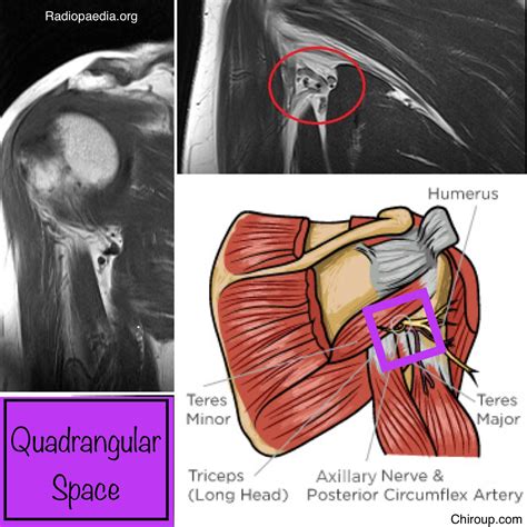 Quadrangular Space Pain JCDR Anatomy, Axillary Nerve, Deltoid