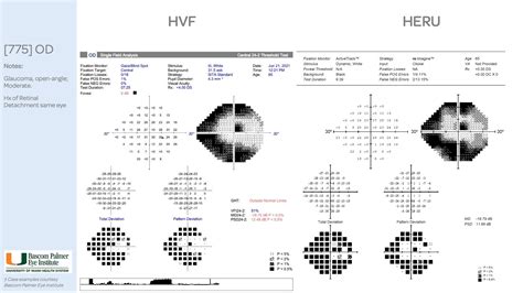 Optometry Forms Office Visual Field Interpretation And Report Printable ...