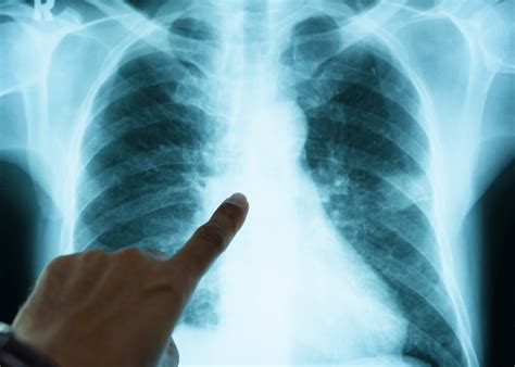 Sklerodermie: Diese Autoimmunkrankheit kann lebensbedrohlich werden