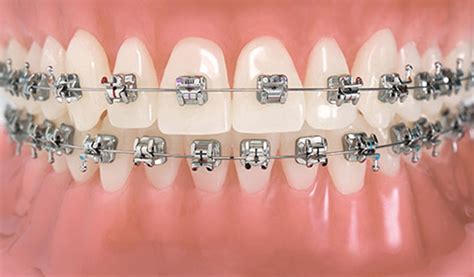 Orthodontic Treatment | Treatments | TEETH CARE