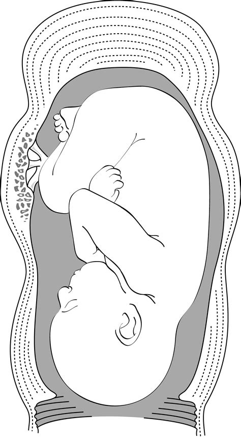 3.3 Uterine rupture | MSF Medical Guidelines