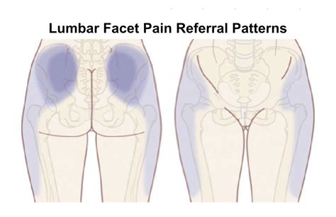 Facet Joint Pain - Back Care Clinic