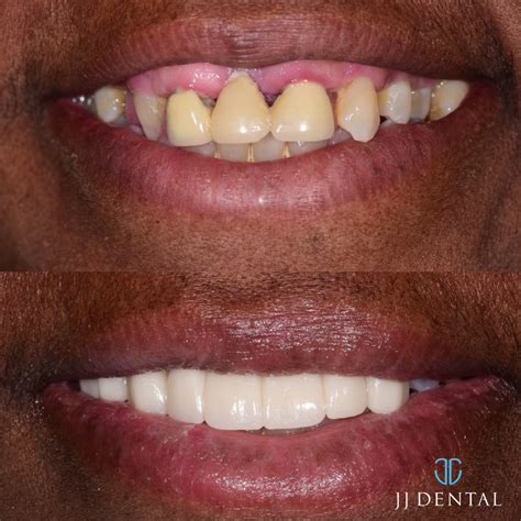 Before & After - JJ Dental