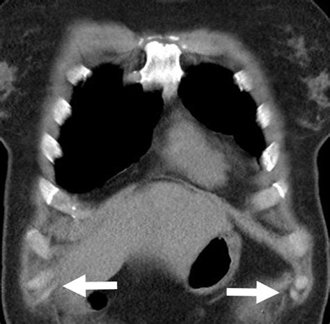 Costal margin reconstruction for slipping rib syndrome: Outcomes of ...