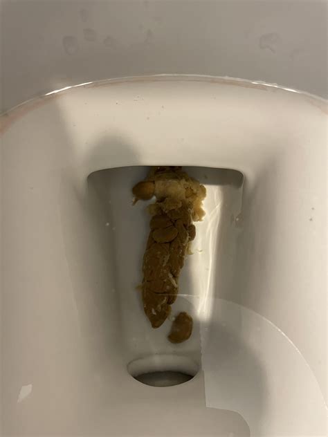 Has anybody had a lot of mucus in their stool (see pics) and received any answers on what’s ...