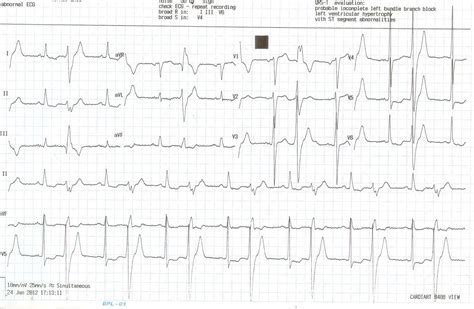 ventricular ectopic beats and mitral regurgitation | Dr.S.Venkatesan MD
