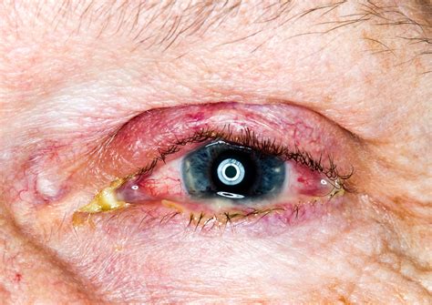 Causes Of Eye Discharge In Adults at Nathan Masterson blog