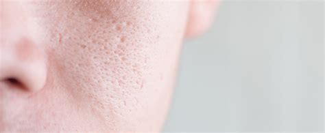 Clogged Pores & How To Unclog Them | Eucerin UK