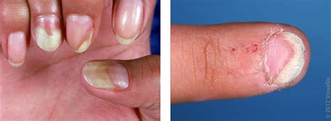 Psoriasis Nails vs. Fungus: Pictures and Differences - GoodRx