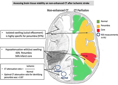 Assessing Brain Tissue Viability on Nonenhanced Computed Tomography ...