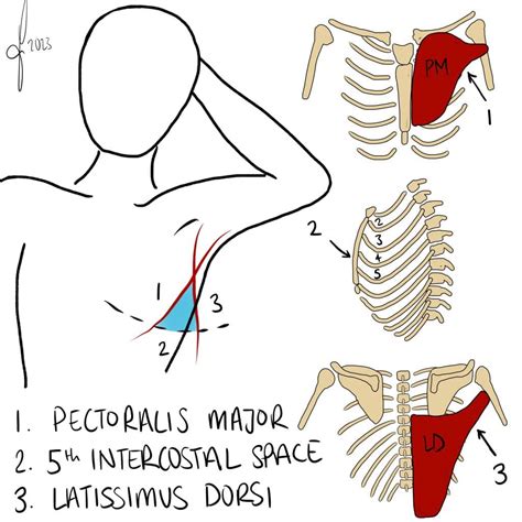Tube Thoracostomy For Tension Pneumothorax at Bonnie Tyler blog