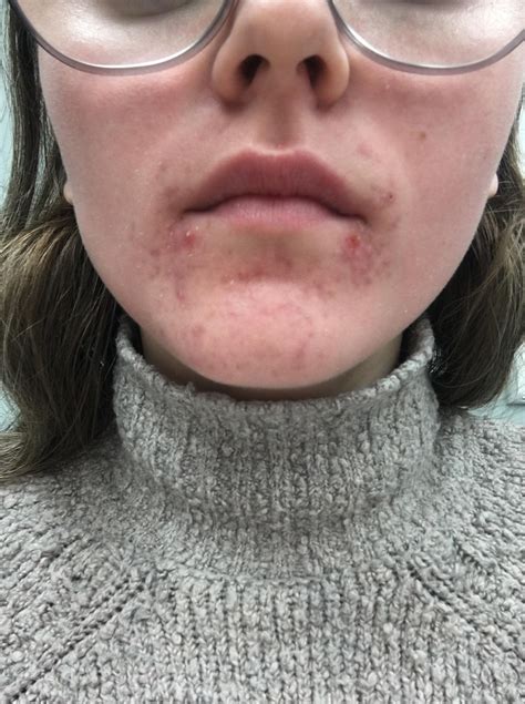 Hormonal Acne Around Mouth
