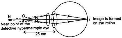 Q.7 Make a diagram to show how hypermetropia is corrected. The near ...