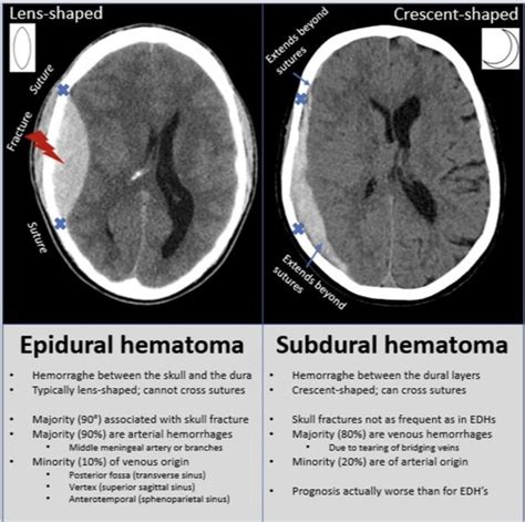 Subdural Hematoma Bridging Veins