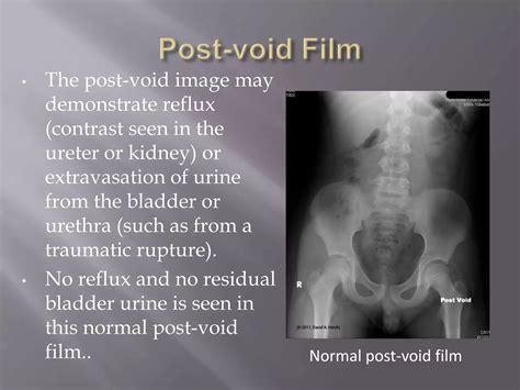 MCU- Micturating cysto-urethrogram | PPTX