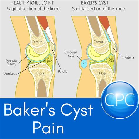 Baker's Cyst Pain | Carolina’s Pain Center
