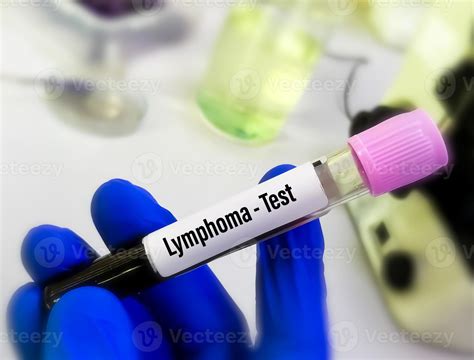 Tests For Lymphoma Cancer