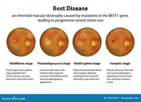 Best Disease Macular Dystrophy