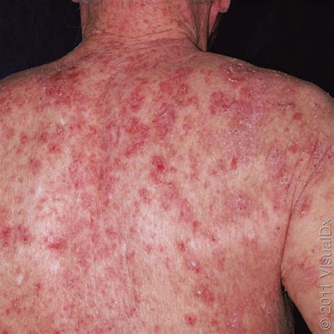 Pemphigus & Pemphigoid Treatment in Salt Lake City, UT | University of Utah Health | University ...