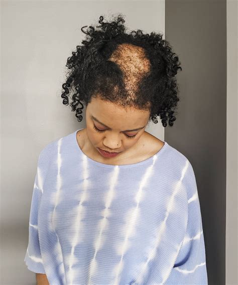 Scarring Alopecia & Chronic Hair Loss Is Prevalent Amongst Black Women - Nola Johnson Shares How ...
