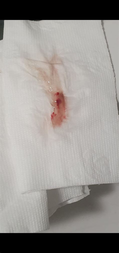 Implantation Bleeding Blood Clot