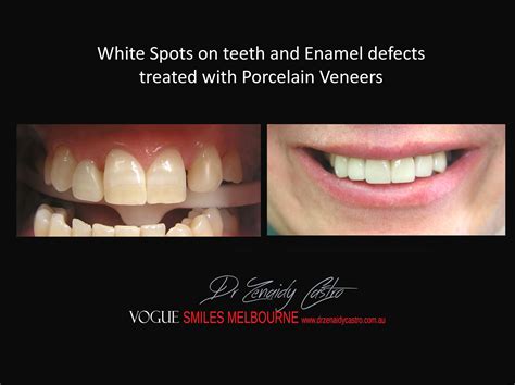 White Spots on Teeth and Enamel Defect Treatment Melbourne