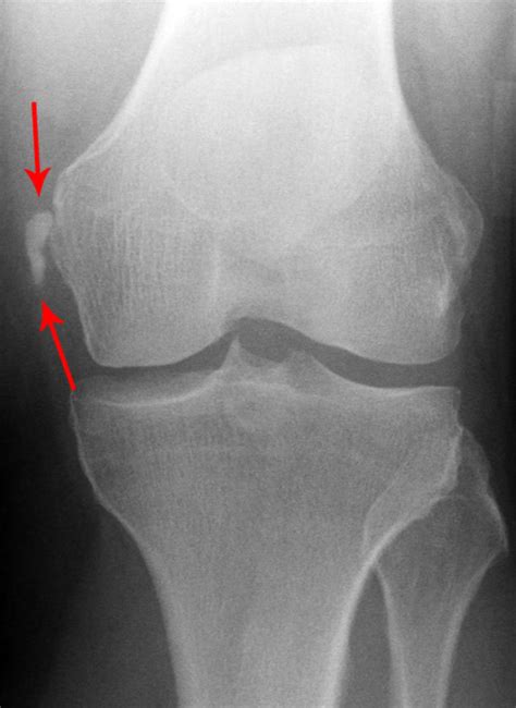 Stieda-Pellegrini-Köhler-Läsion - DocCheck Flexikon