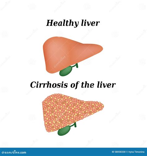 Hepatoma Cartoons, Illustrations & Vector Stock Images - 15 Pictures to ...