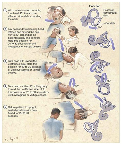 Benign paroxysmal positional vertigo epley maneuver - miisse