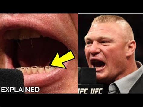 What's wrong with Brock Lesnar's Teeth Explained - YouTube