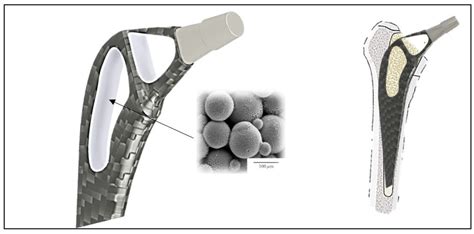 Topology Optimization of a Femoral Stem in Titanium and Carbon to Reduce Stress Shielding with ...