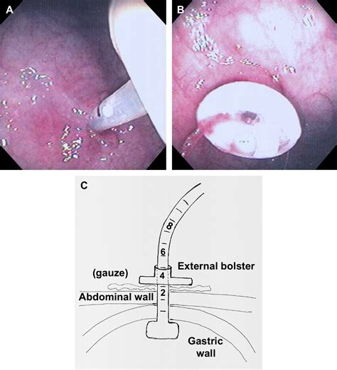 Spectrum of Morbidity Related to Bolster Placement at Time of Percutaneous Endoscopic ...